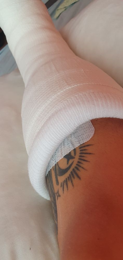 A casted broken leg.