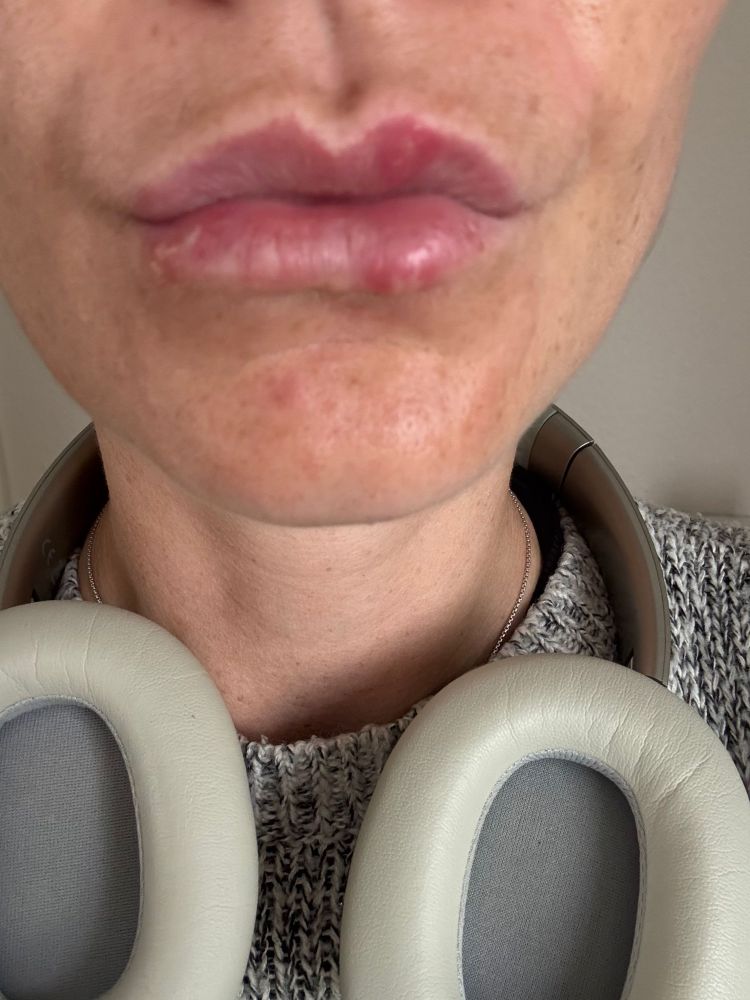 Three whopper cold sores