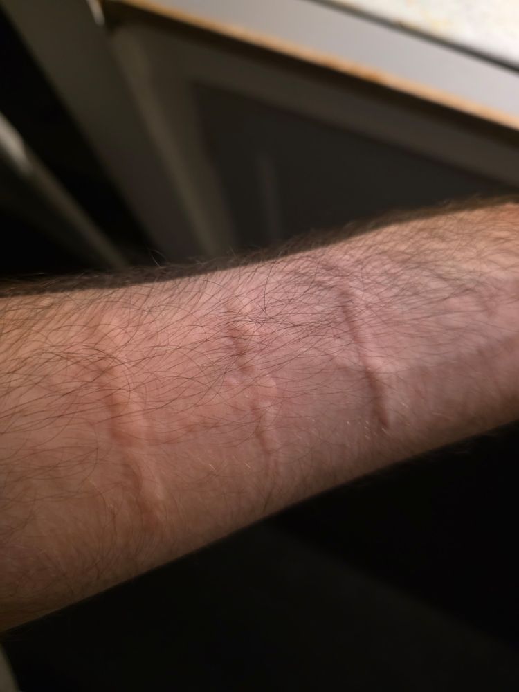 Dermatographia, my skin says HI after lightly scratching it
