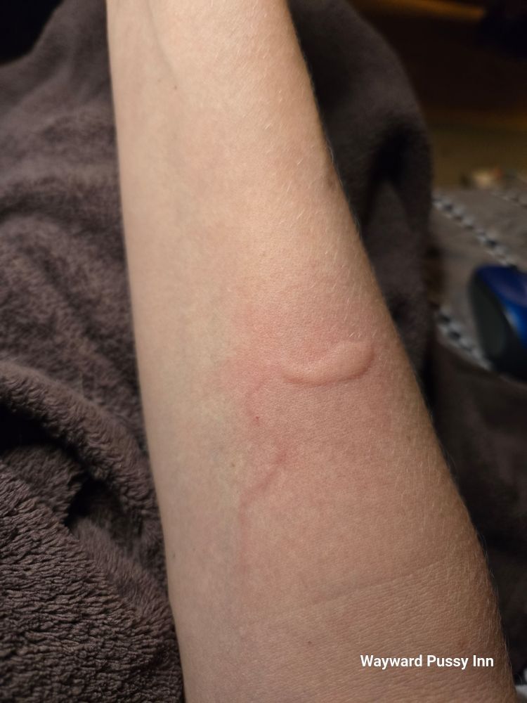 8 mins after i noticed what I though was a mosquito bite