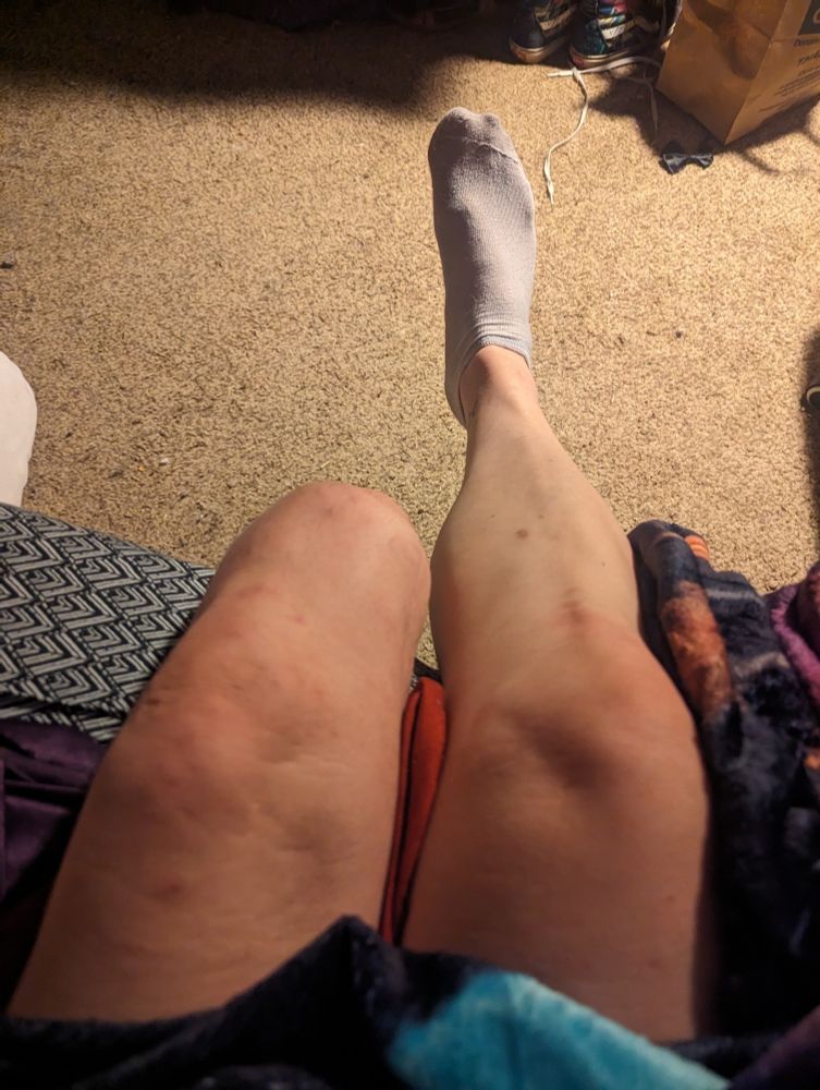 My legs hanging off the edge of the bed.  The right leg has a sock on the foot. The left leg ends a bit after the knee.