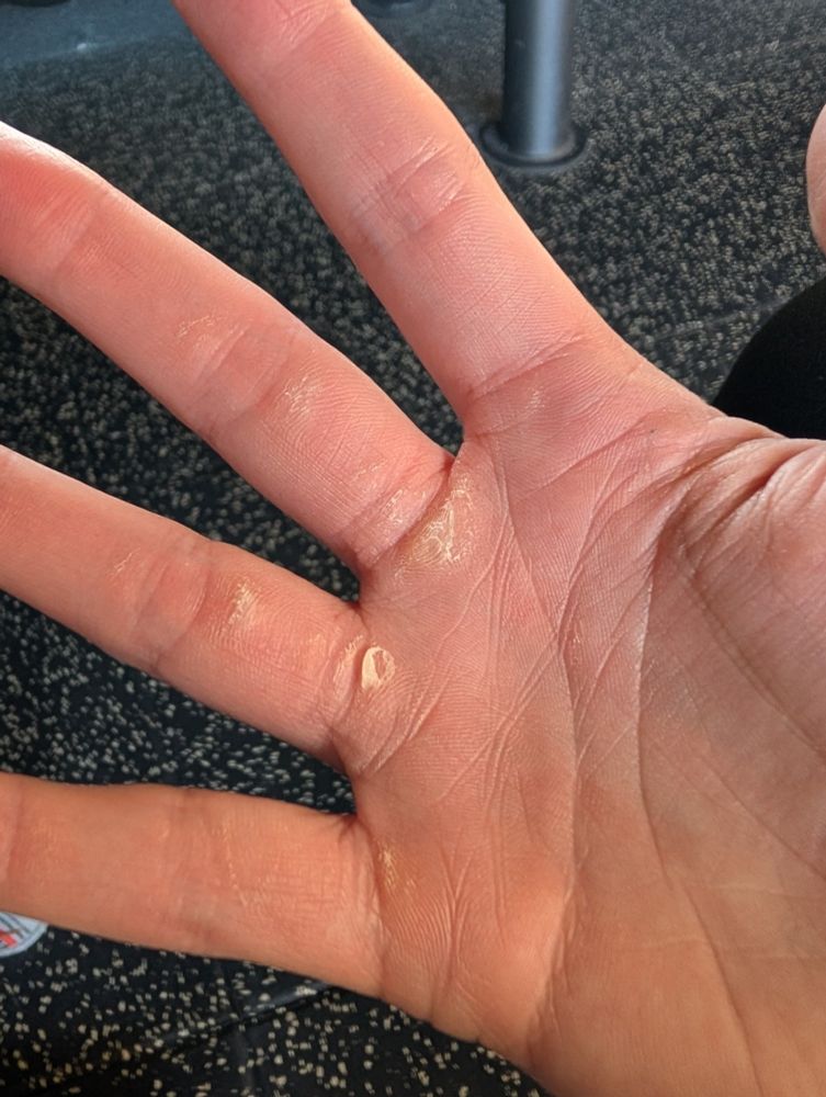 Molly's rotten calluses on her hand