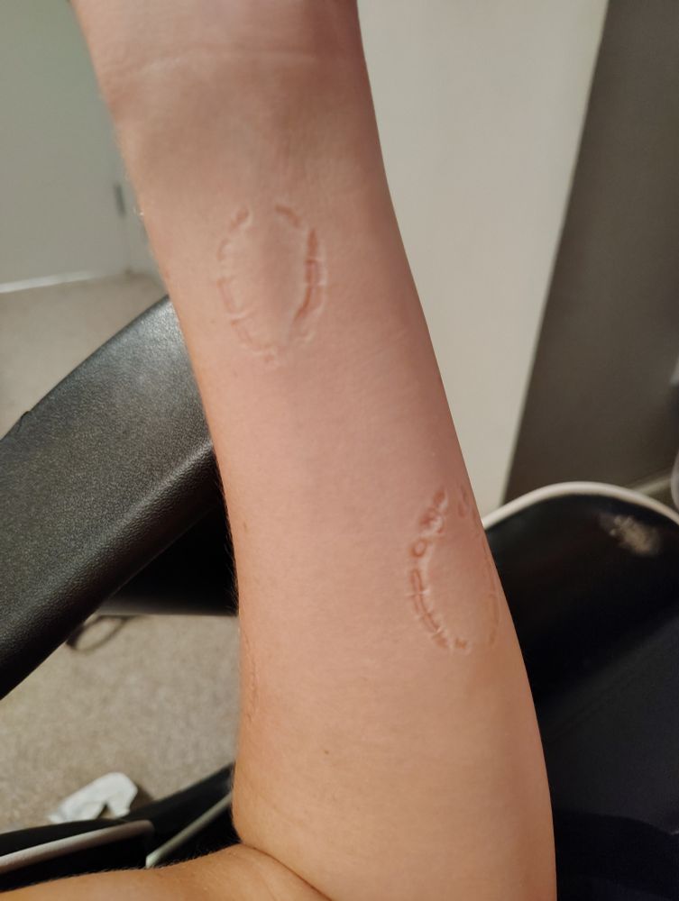 Maria's arm with a couple bite marks. One close to the wrist and one in the near middle of her forearm.