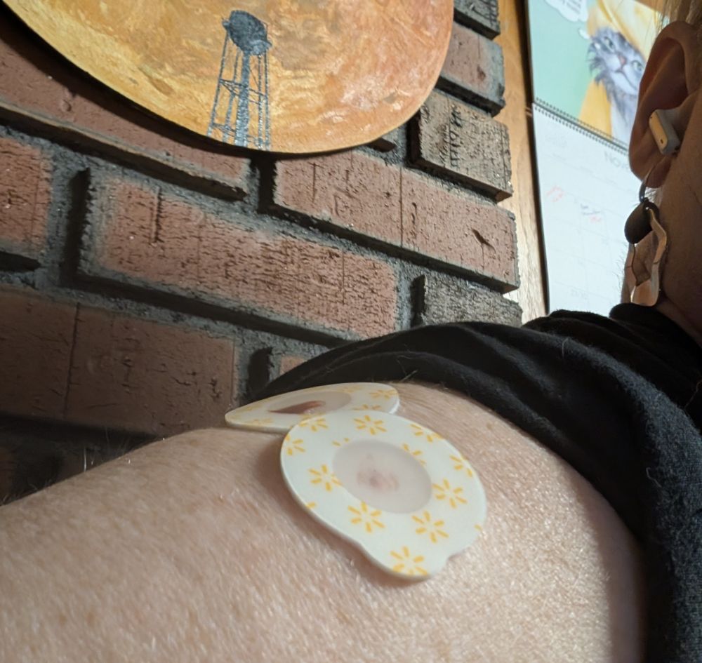 Closeup of the top of my right arm, near the shoulder. I'm sporting 2 of those round post-vax bandaids that for some reason have a foam border and then a see-thru center. There's a spot of blood from each injection site (more from the COVID jab site at the back bc I wasn't ready & kicked the pharmacist, sorry again, Andrea), so the bandaids kind of look like goggles. Or bewbs.