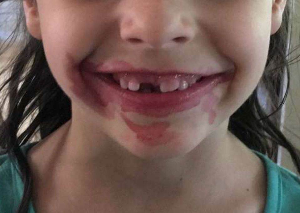 Little girl’s smile missing an upper front tooth and covered in something that was clearly delicious and pink.