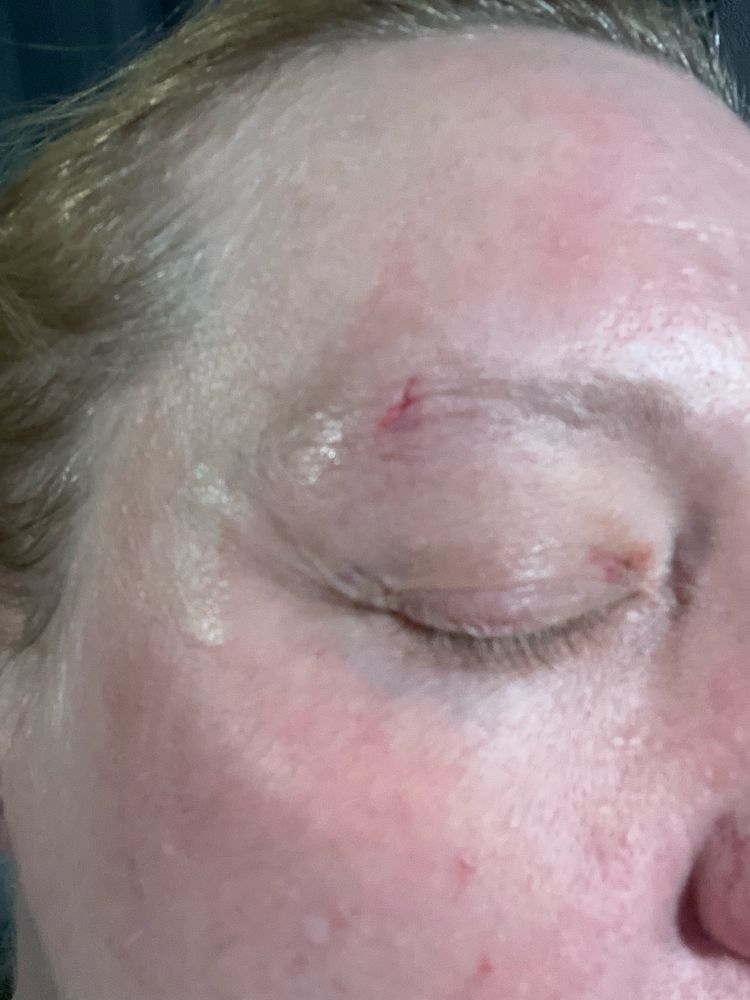 A white woman’s face with a lacerated right eyebrow, swelling and bruising around the eye. 