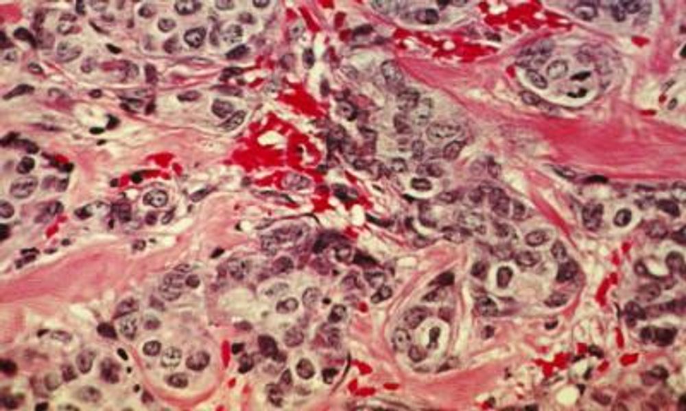 Fibrosis a prognostic biomarker for HER2-negative breast cancer