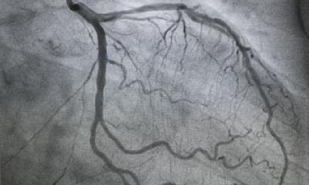 Coronary bypass: new insights on ‘no-touch’ vein harvesting