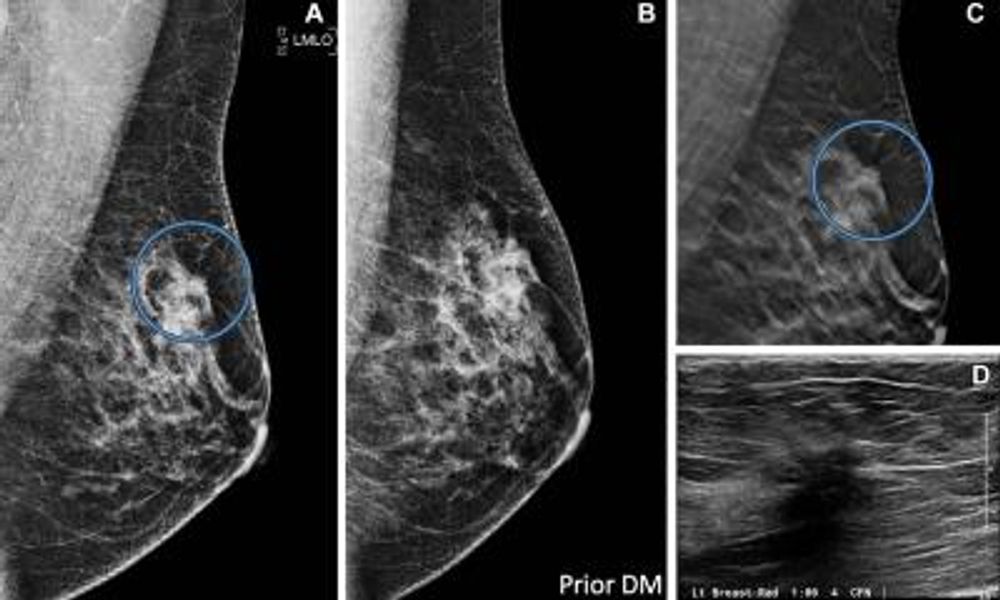 Decade of DBT: 10-year study shows benefits of tomosynthesis