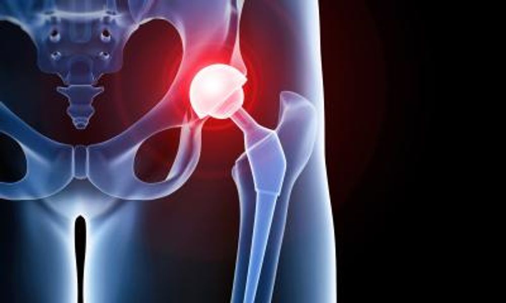 Force sensor to improve hip replacement surgery