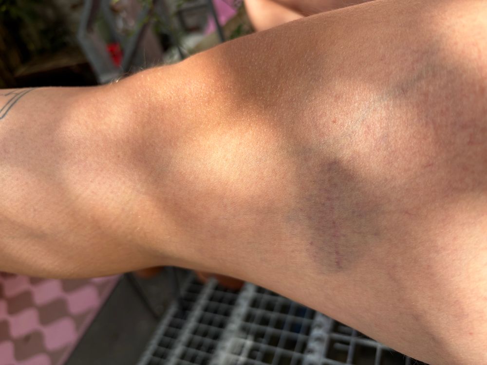 hämatom auf einem oberschenkel 