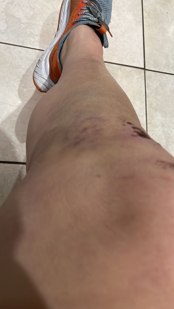
Back to running… hurting on coming up from full flexion. Any ideas on rehab exercises? From a bike fall last week for reference 
