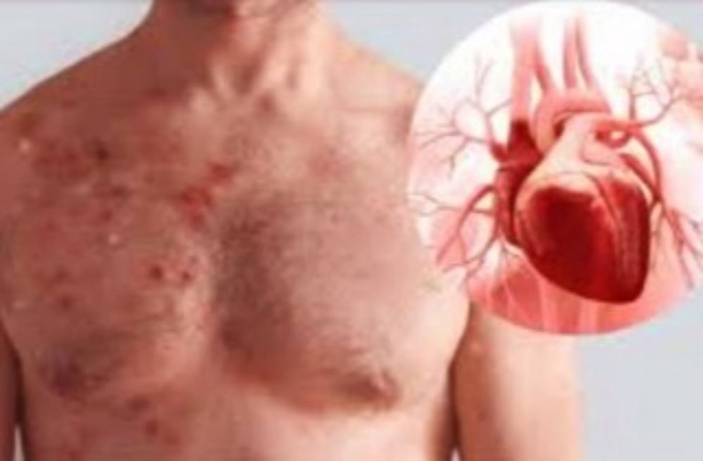 Mpox (Monkeypox) can also cause vascular inflammation and affect cardiovascular health! - Thailand Medical News