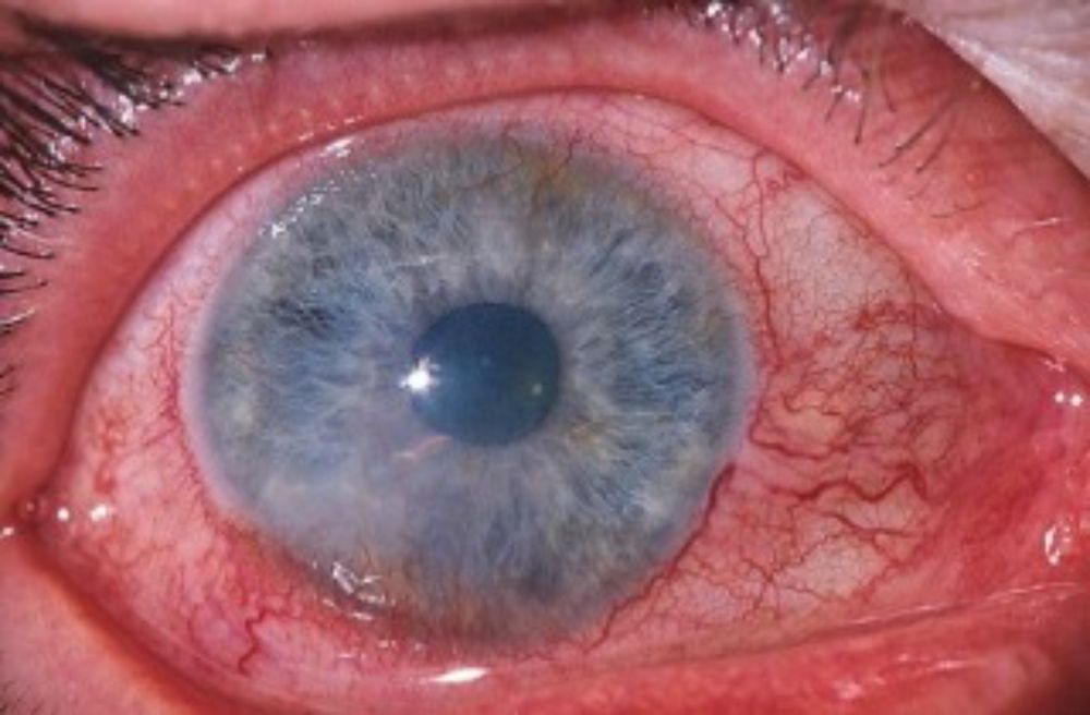 Intestinal Inflammation Found to Be Linked with Glaucoma - Thailand Medical News