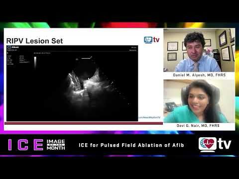 ICE Image of the Month: ICE for PFA Ablation of AFib