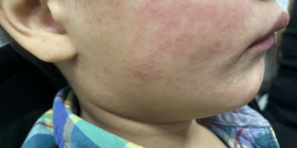 Record measles outbreak in Oregon blamed on vaccine exemptions