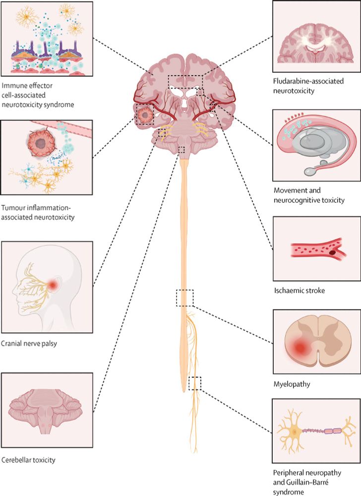 Figure showing CAR T-cell therapy-associated neurotoxicities. Copyright: Elsevier Ltd. All rights are reserved, including those for text and data mining, AI training, and similar technologies.