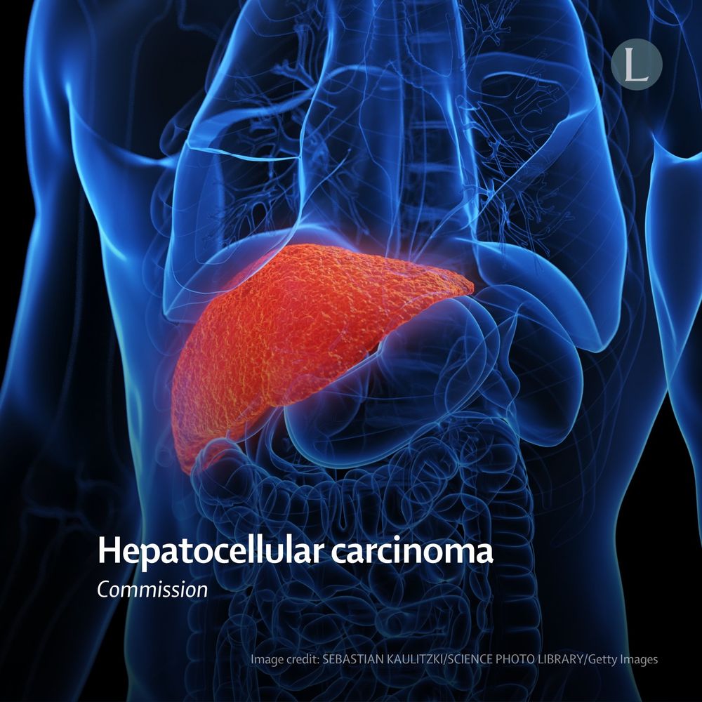 Promotional card for The Lancet Commission on hepatocellular carcinoma. Background image depicts a computer-generated illustration of a human torso with an inflamed liver. 
