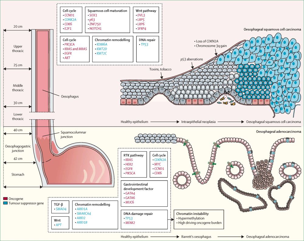 Figure showing genomic changes during the development of oesophageal cancer. Copyright: 2024 Elsevier Ltd. All rights are reserved.