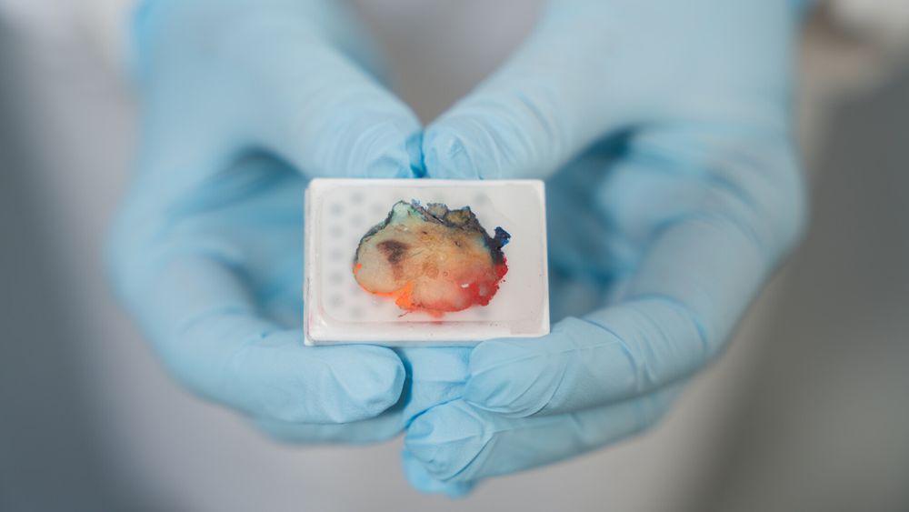 Gloved hands holding a block containing a piece of cancer tissue