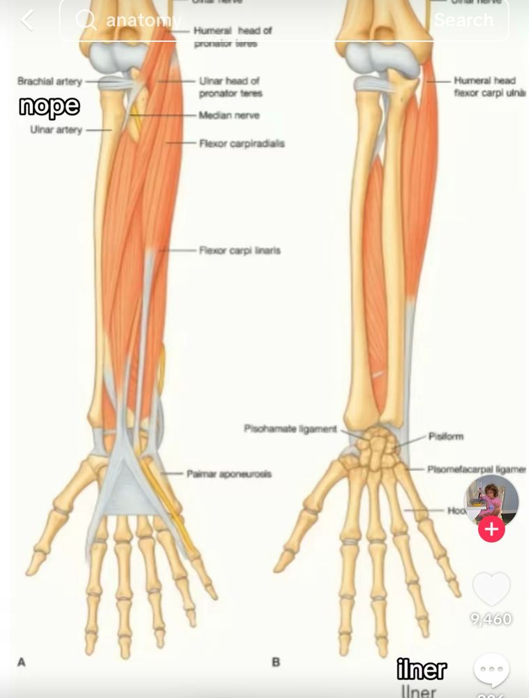 An AI generated diagram of the bones of the hand and forearm. This time AI says we have 6 digits. It also says that the radius is the ulnar artery. Among other many issues. 