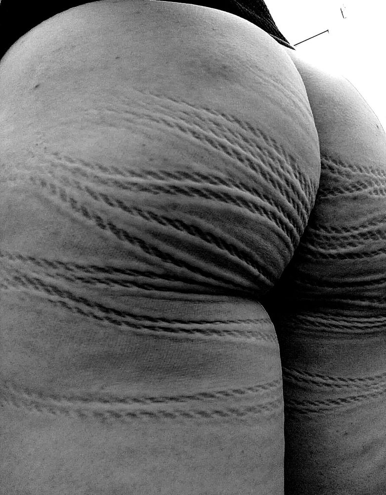Schwarz-weiß-Foto meines Hinterns, auf dem sich Kreuz und quer tiefe Ropemarks abzeichnen