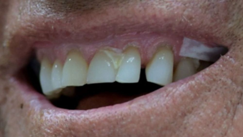 A close up of RFKs filthy teeth and a nicotine pouch hiding in his gums.