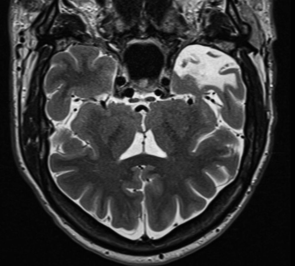 MRI of brain showing gliosis where tissue was removed from the right temporal lobe.