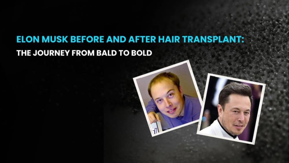 Elon Musk Before and After Hair Transplant: The Journey from Bald to Bold