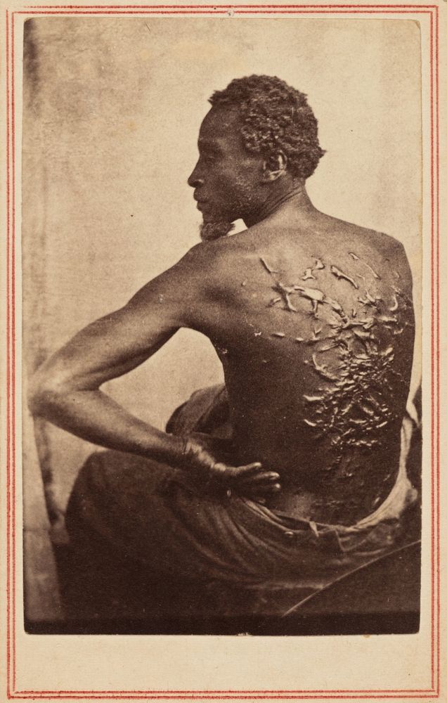 19th century photo of the scars and welts on the back of a black man who had been scourged as a slave. 