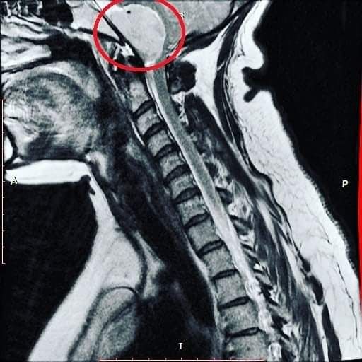 A left-side profile MRI of a human head, neck, and shoulder. The image has a red circle around a white mass on the brain stem, circling a brain tumor where the brain connects to the spine. 