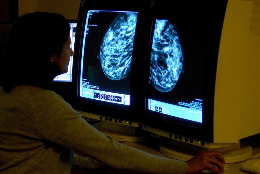 More than a third of women did not take up breast-screening offer last year