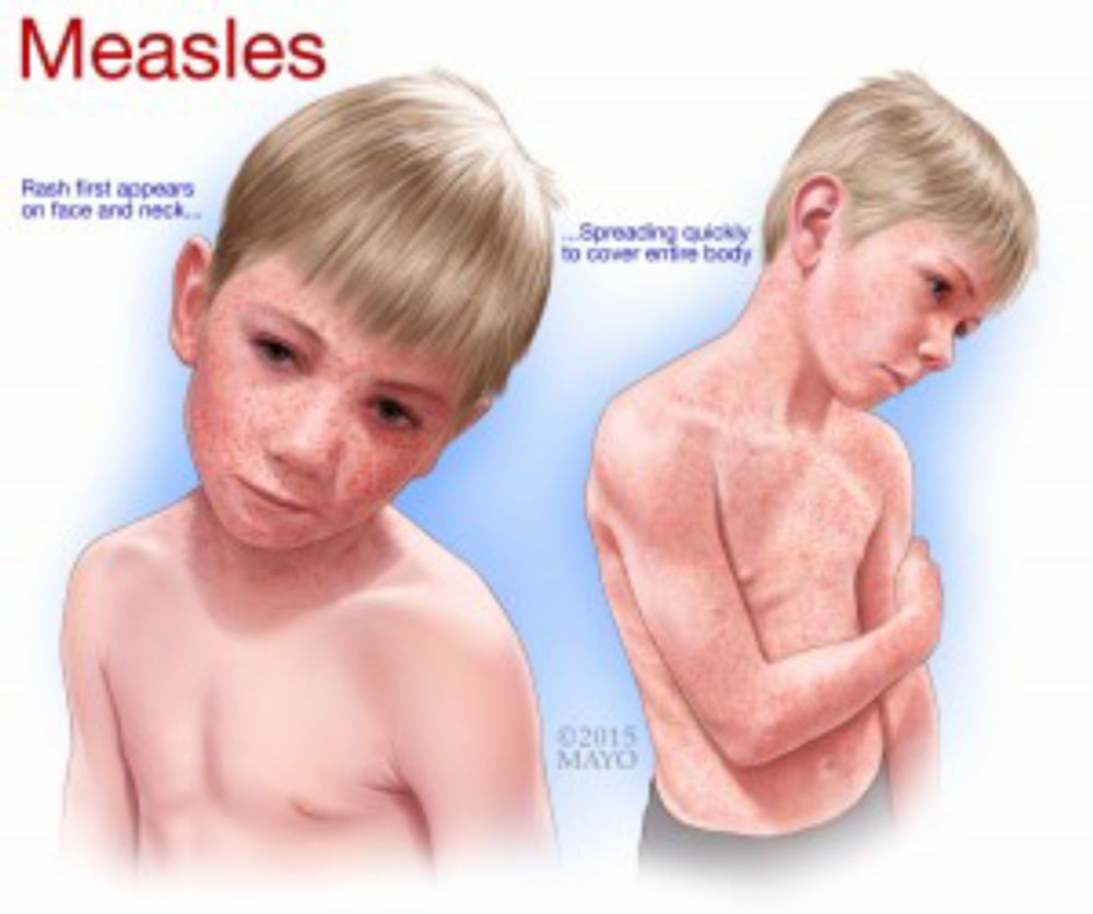 Expert Alert – Measles and Hearing Loss - Mayo Clinic News Network