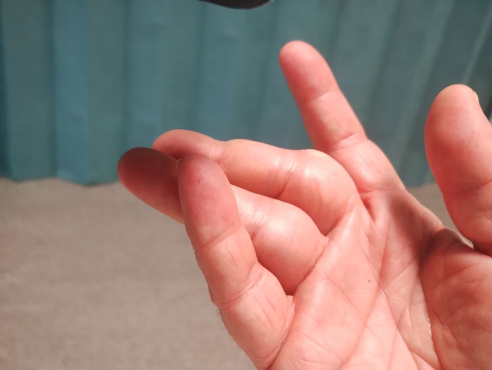 My right hand, with middle and ring fingers bent completely the wrong way.