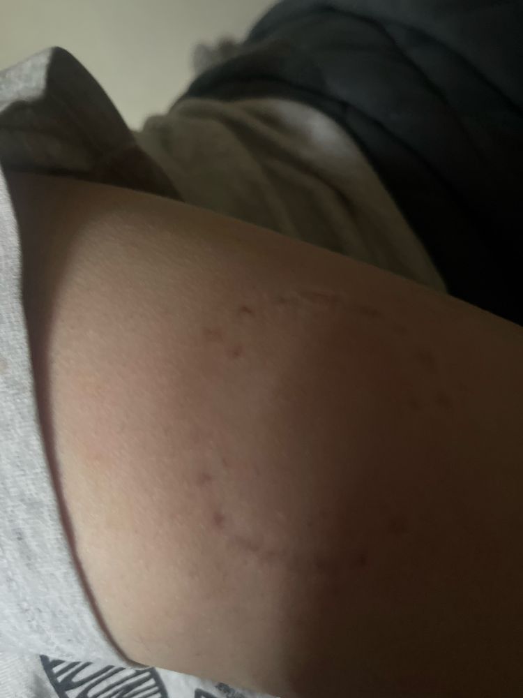photo of a bite mark on Bea's arm