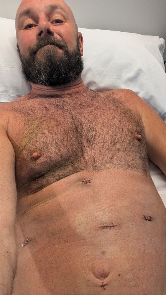 Me not looking too upset about all the metal stitches. 