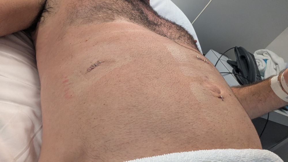 Metal stitches on my left side 