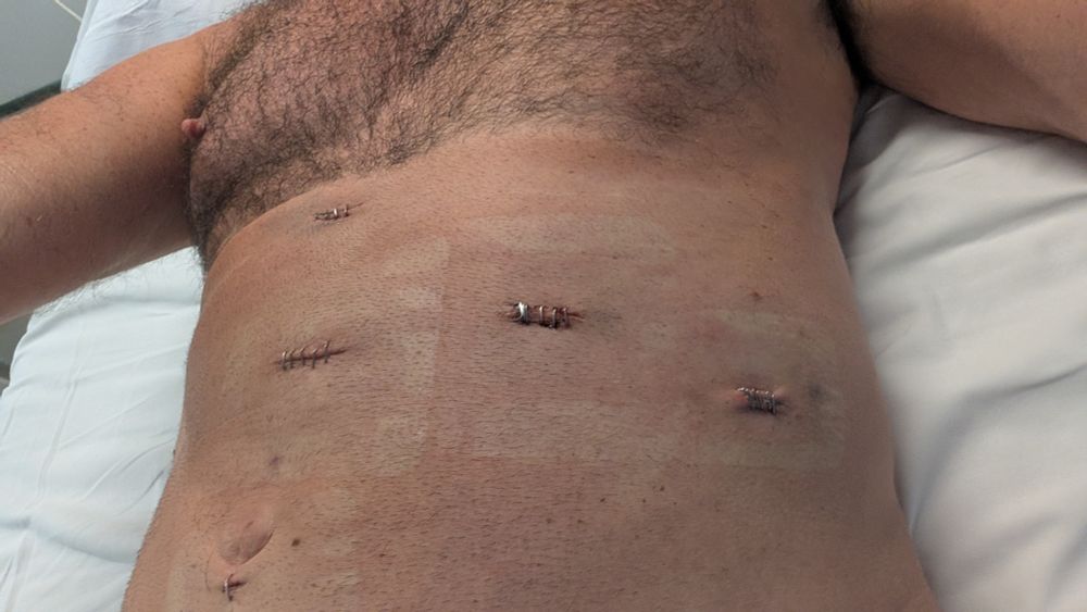 Metal stitches across my middle and right abdomen. 