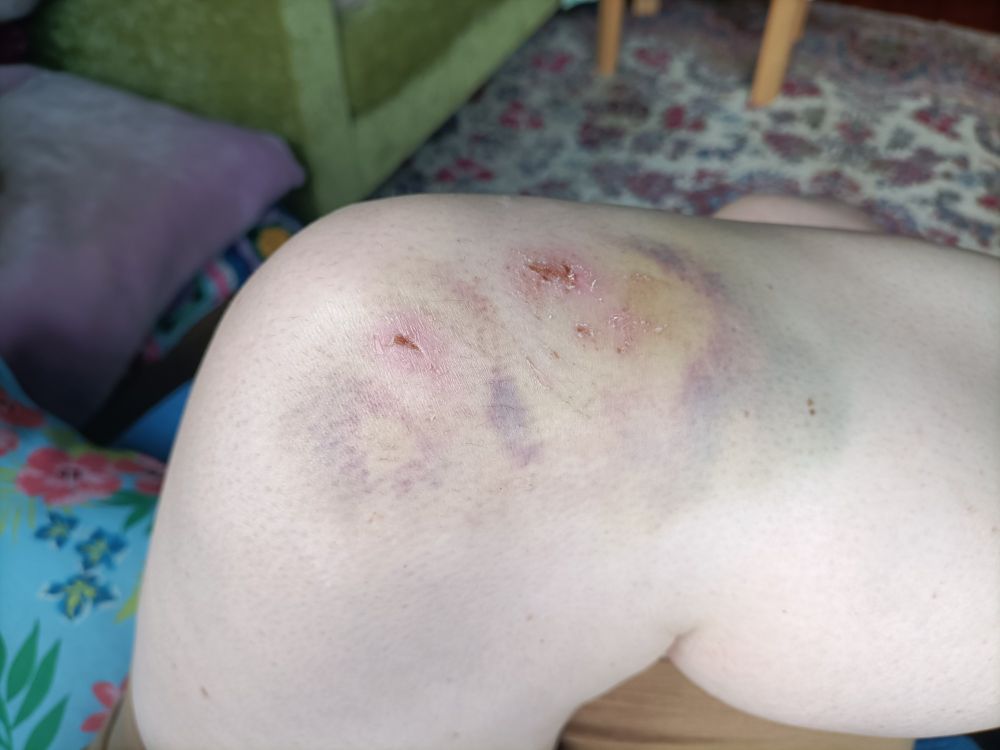 big bruise 