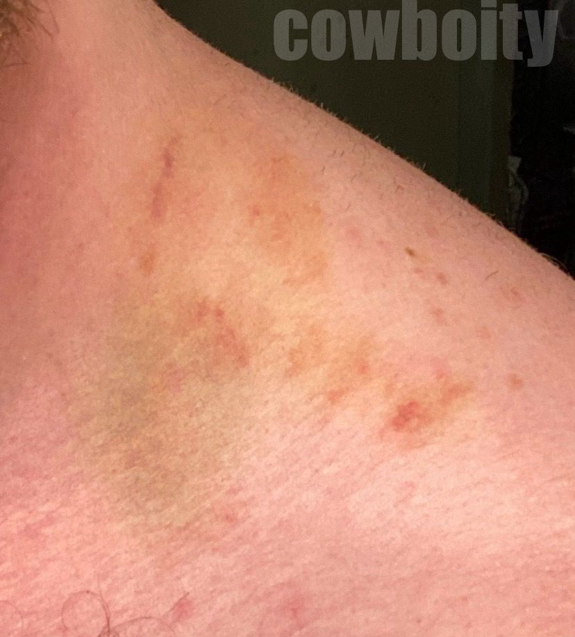 A flogging bruise three days later