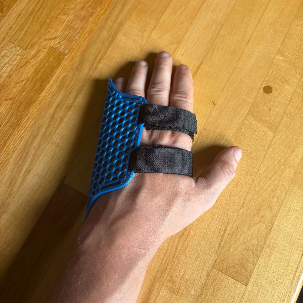 The back of a left hand. Its wrapped in a blue plastic honeycomb splint attached with black straps.