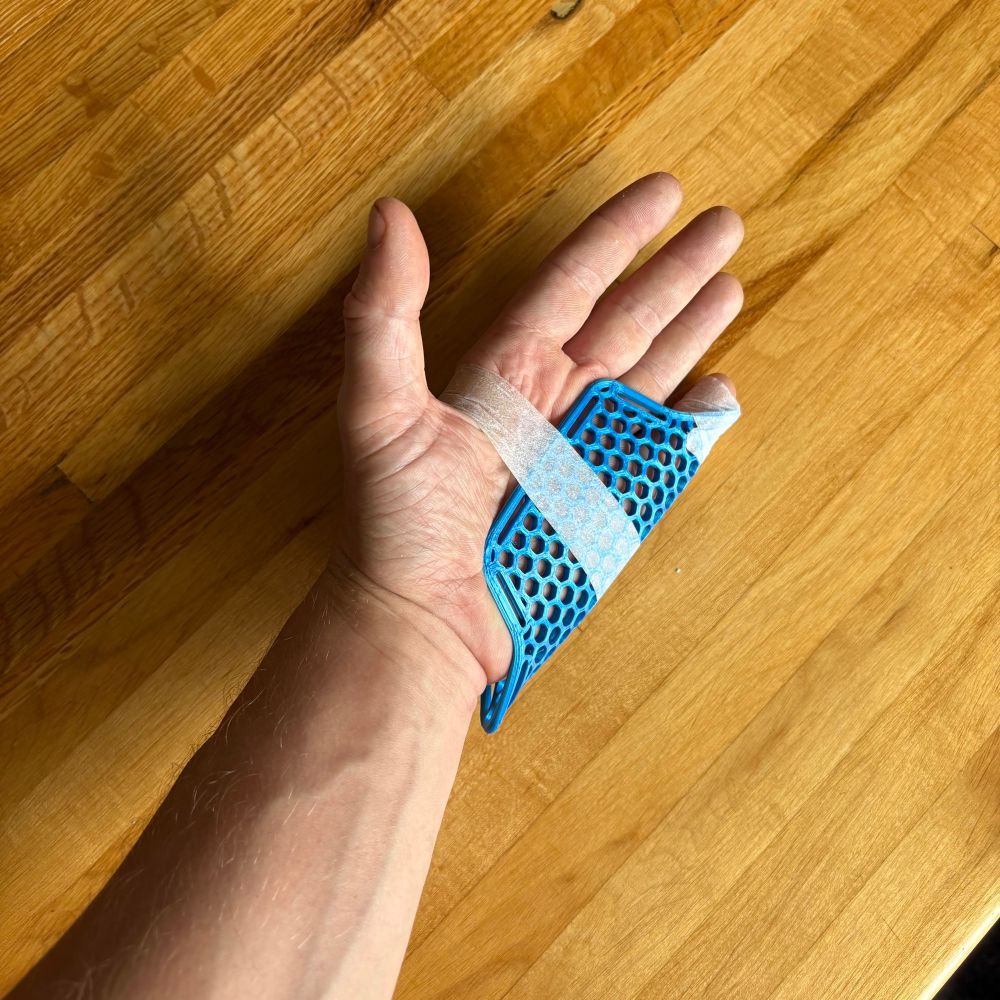 A left hand with a blue plastic splint around the pinky side.