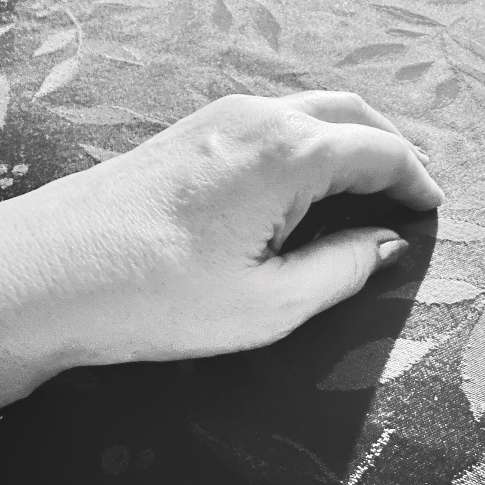 My swollen left hand.