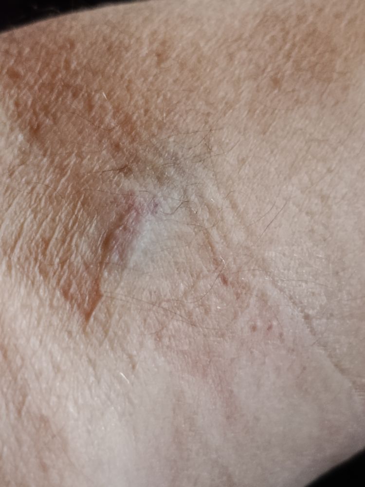 Ganz schön verstochen, beim Blut abnehmen. Kein Wunder hat es etwas geschmerzt. 