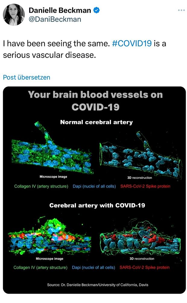 Danielle Beckman @DaniBeckman

I have been seeing the same. #COVID19 is a serious vascular disease.

Your brain blood vessels on
COVID-19