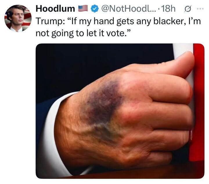 A closeup of trump's right hand, bruised to be almost black. The caption has a fake quote by Trump that says 