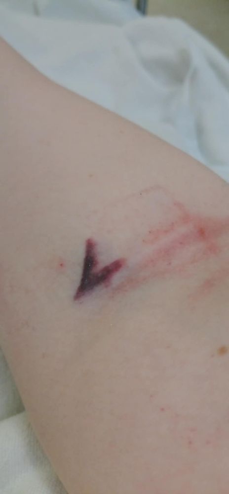 Photo of my one failed IV in my right arm.